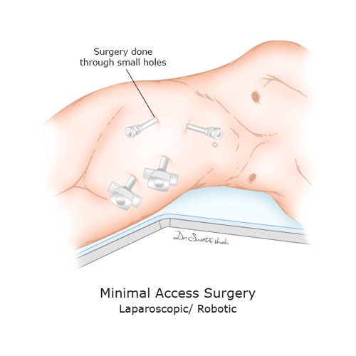Minimal-Access-Surgery.png