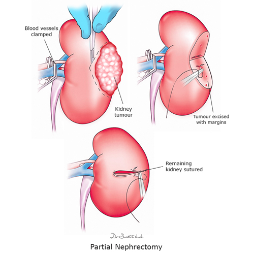 Partial-Nephrectomy.png