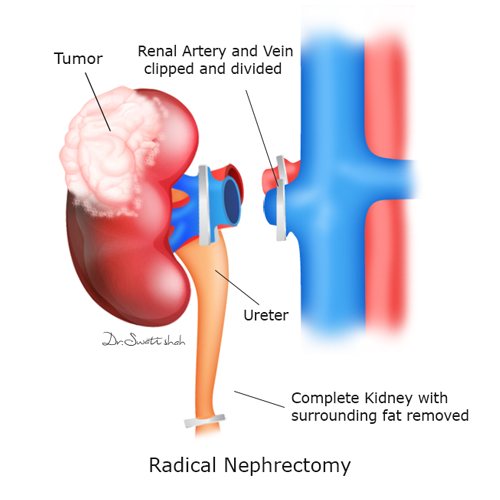 Radical-Nephrectomy.png