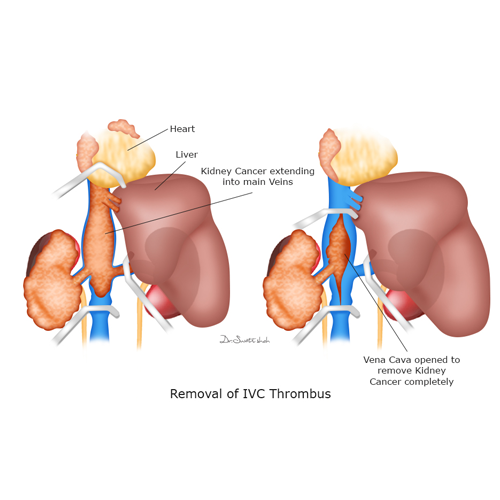 Removal-of-IVC-Thrombus.png