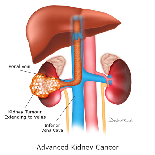 advanced-kidney-cancer.png