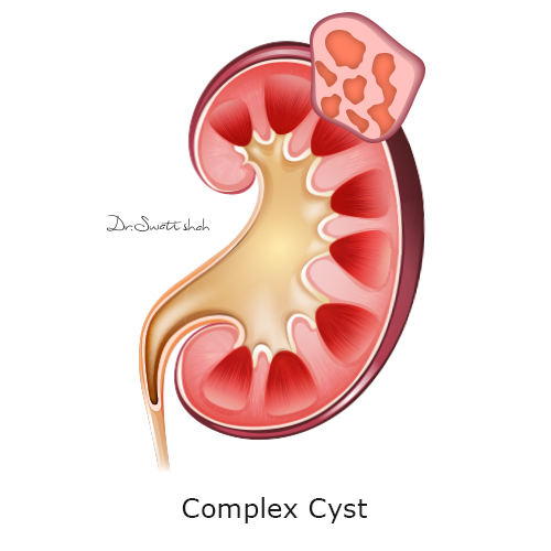 complex-cyst.png