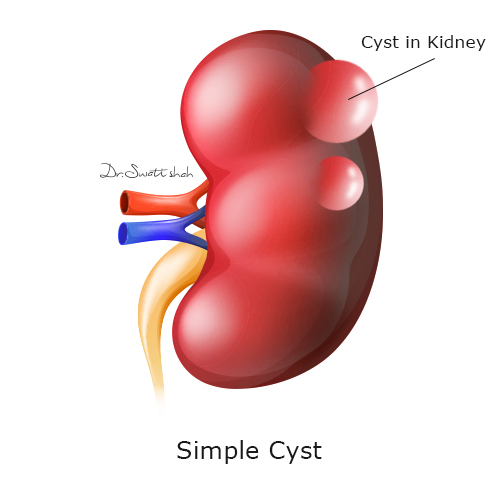 simple-cyst.png