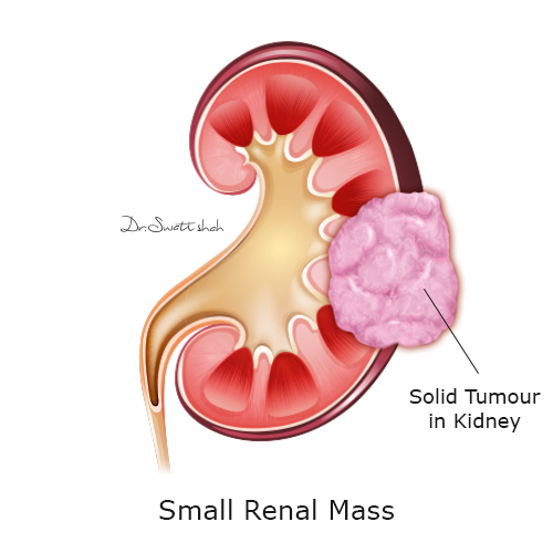 small-renal-mass.png
