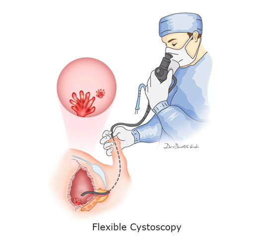 Flexible-Cystoscopy.png