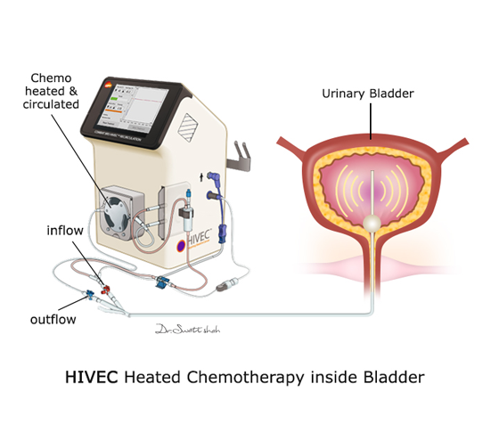 HIVEC-Hyperthermic-Intra-Vasical-Chemotherapy.png