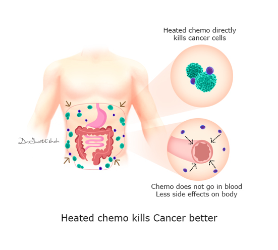 Heated-chemo-kills-Cancer-better.png