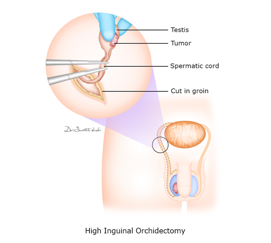 High-Inguinal-Orchidectomy.png