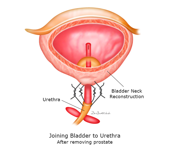 Joining-Bladder-to-Urethra-after-removing-prostate.png
