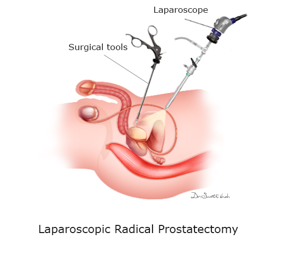 Laparoscopic-Radical-Prostatectomy
