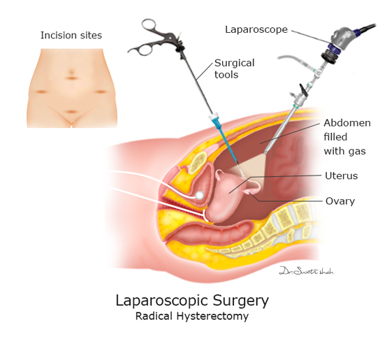 Laparoscopic-Surgery.png