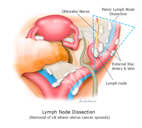 Lymph-Node-Dissection.png