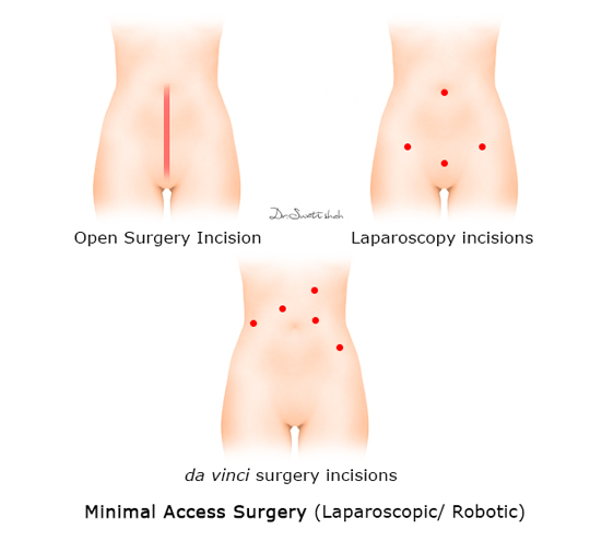 Minimal-Access-Surgery.png