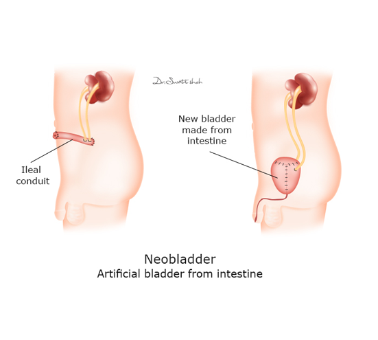 Neobladder.png