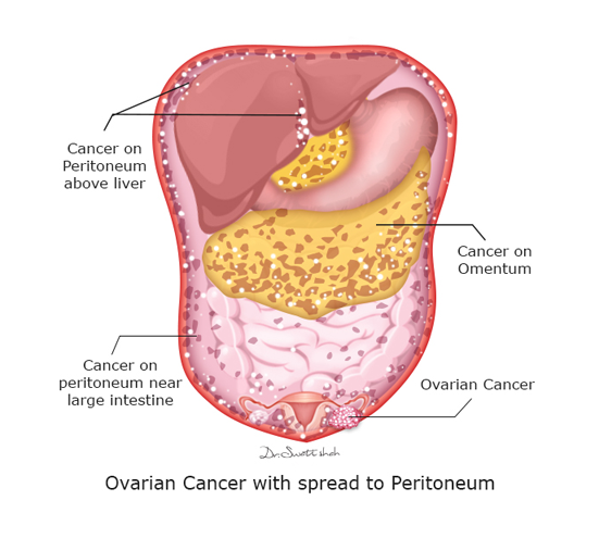 Ovarian-Cancer-with-spread-to-Peritoneum.png
