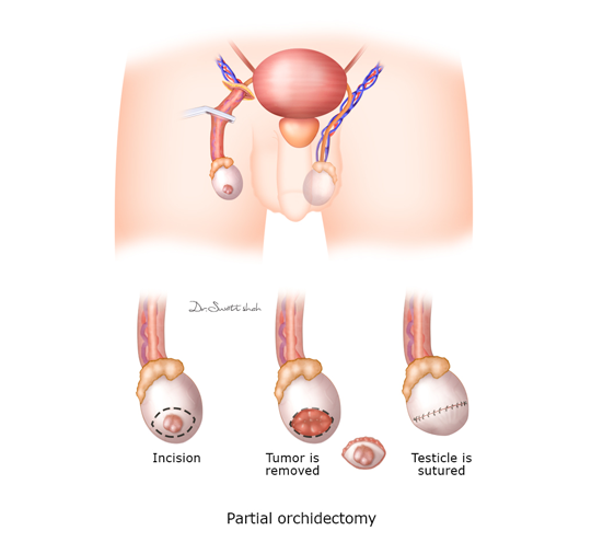 Partial-orchidectomy.png