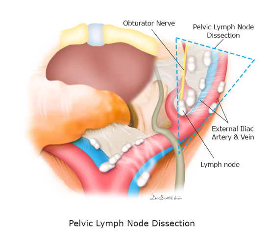 Pelvic-Lymph-Node-Dissection.png