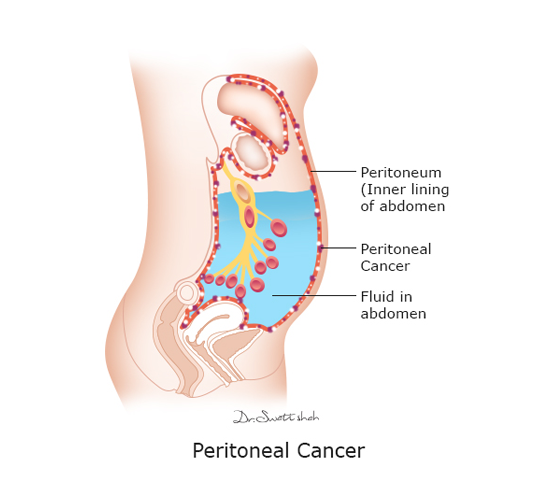 Peritoneal-Cancer.png