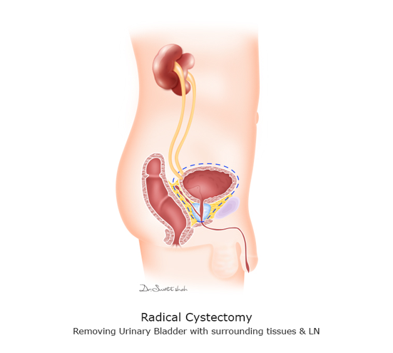 Radical-Cystectomy.png