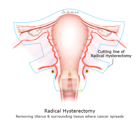 Radical-Hysterectomy.png