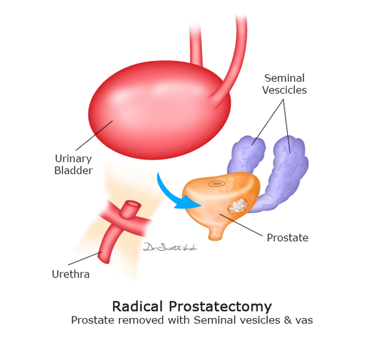 Radical-Prostatectomy-Prostate-removed-with-seminal-vesicles-vas.png