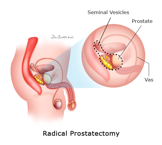 Radical-Prostatectomy.png