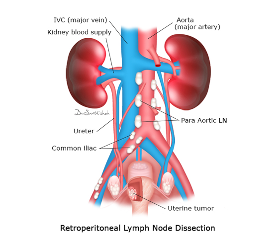 Retroperitoneal-Lymph-Node-Dissection-1.png