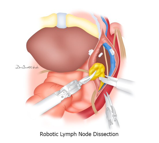 Robotic-Lymph-Node-Dissection.png