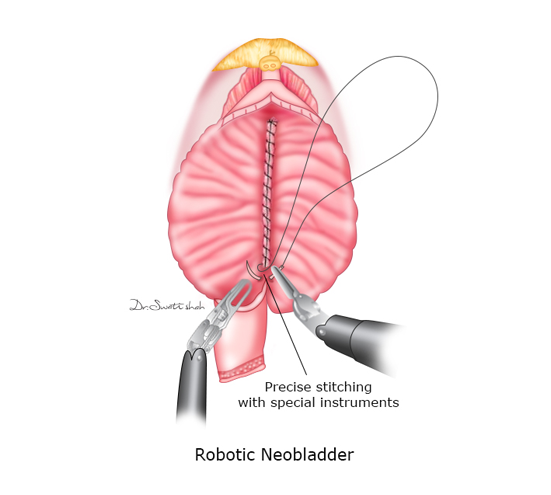 Robotic-Neobladder.png
