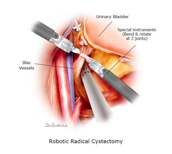 Robotic-Radical-Cystectomy.png