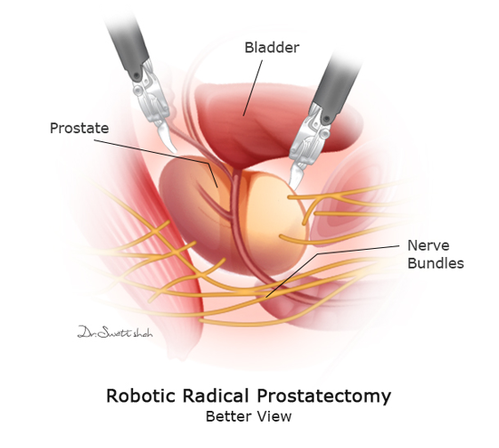 Robotic-Radical-Prostatectomy-Better-View