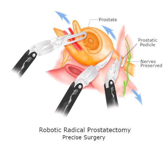 Robotic-Radical-Prostatectomy-Precise-Surgery