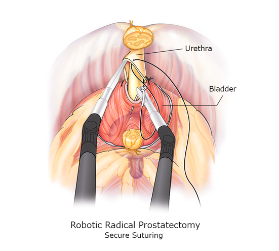 Robotic-Radical-Prostatectomy-Secure-Suturing