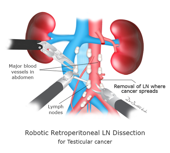 Robotic Retroperitoneal LN Dissection for Testicular cancer