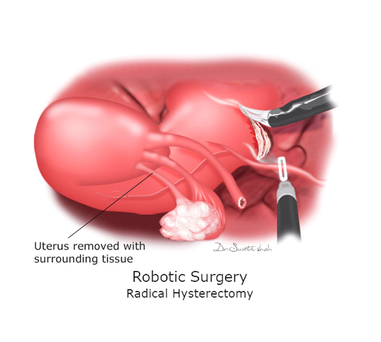 Robotic-Surgery2.png