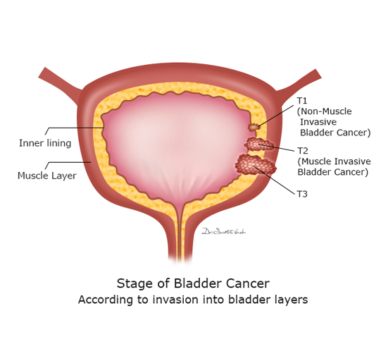 Stage of Bladder Cancer