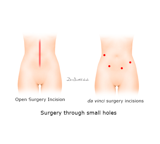 Surgery-through-small-holes.png