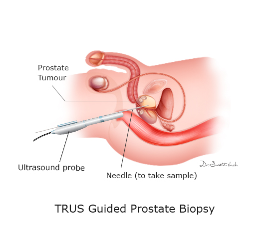 TRUS-Guided-Prostate-Biopsy