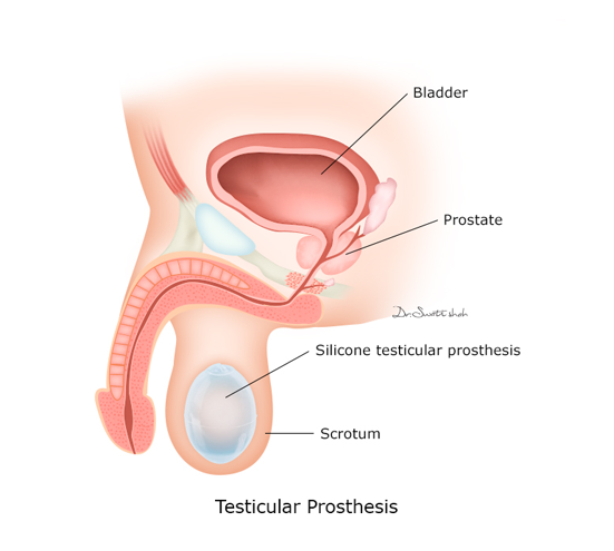 Testicular-Prosthesis.png