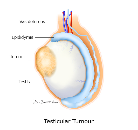 Testicular-Tumour