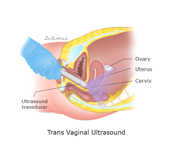 Trans-Vaginal-Ultrasound.png