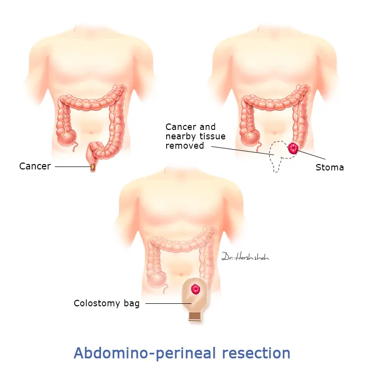 Abdomino perineal resection