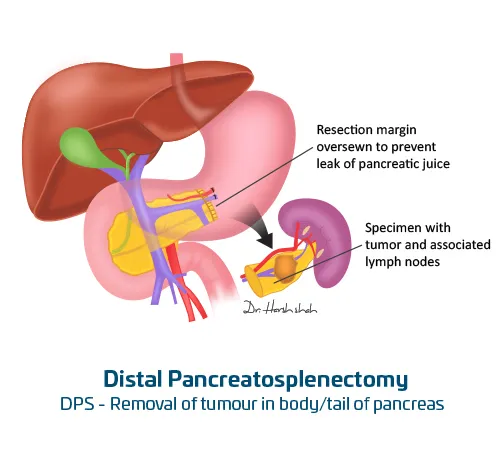 Distal-Pancreatosplenectomy