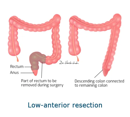 Low anterior resection