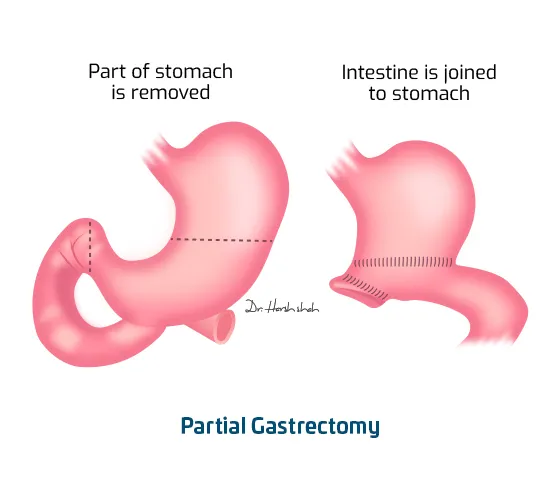 Robotic Partial Gastrectomy for Stomach Cancer
