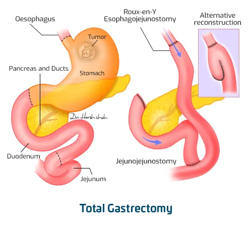 Total Gastrectomy for stomach cancer