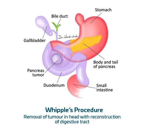 Whipple’s-Procedure
