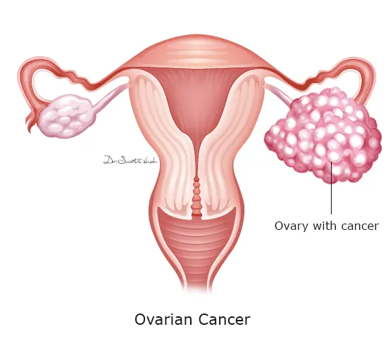 Ovary with cancer
