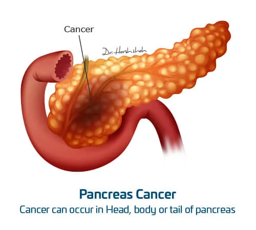 Pancreas-Cancer