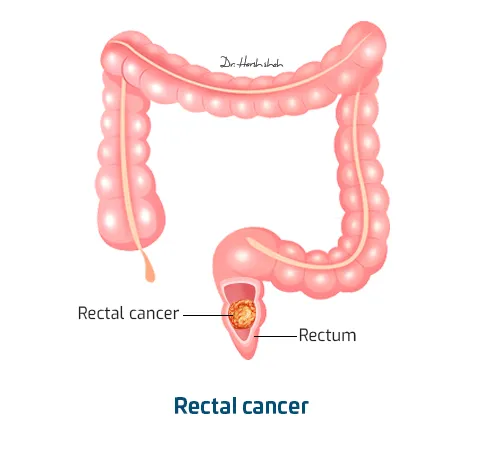 Rectal-cancer